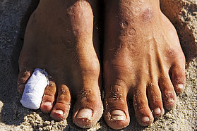 Battle scars on Traversa's feet